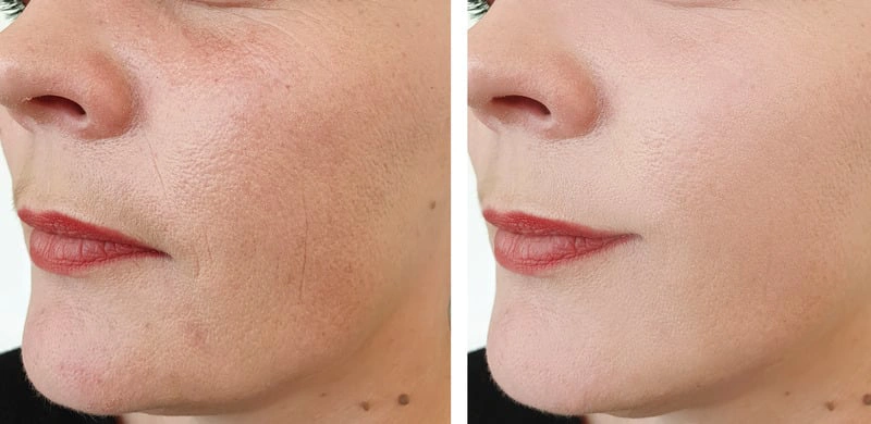 acne treatments
